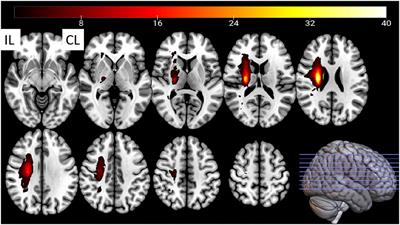 Sensorimotor Responses in Post-Stroke Hemiplegic Patients Modulated by Acupuncture at Yanglingquan (GB34): A fMRI Study Using Intersubject Functional Correlation (ISFC) Analysis